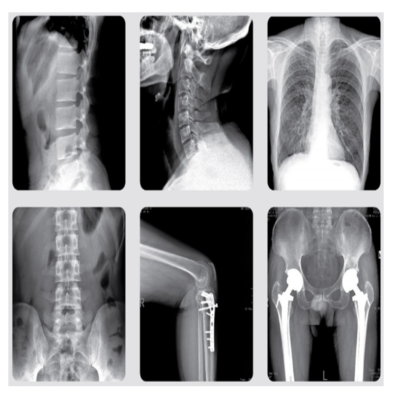 High Image Quality Digital High Frequency U-Arm Radiography System